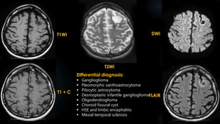 T2WI
T1WI
T1 + C
DWI
FLAIR
Differential diagnosis:
 Ganglioglioma
 Pleomorphic xanthoastrocytoma
 Pilocytic astrocytoma
 Desmoplastic infantile ganglioglioma
 Oligodendroglioma
 Choroid fissural cyst
 HSE and limbic encephalitis
 Mesial temporal sclerosis
 