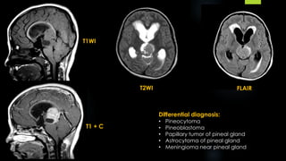 T1WI
T1 + C
T2WI FLAIR
Differential diagnosis:
• Pineocytoma
• Pineoblastoma
• Papillary tumor of pineal gland
• Astrocytoma of pineal gland
• Meningioma near pineal gland
 