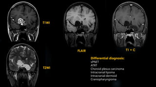 T1WI
T2WI
FLAIR T1 + C
Differential diagnosis:
sPNET
ATRT
Choroid plexus carcinoma
Intracranial lipoma
Intracranial dermoid
Craniopharyngioma
 