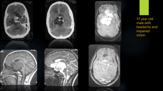 17 year old
male with
headache and
impaired
vision
 