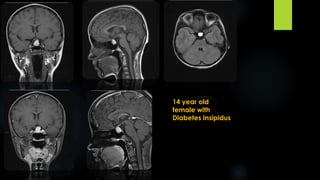 14 year old
female with
Diabetes Insipidus
 