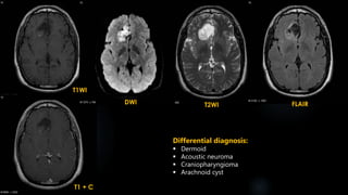 T1 + C
T1WI
DWI T2WI FLAIR
Differential diagnosis:
 Dermoid
 Acoustic neuroma
 Craniopharyngioma
 Arachnoid cyst
 