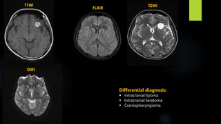 T
T1WI
FLAIR
T2WI
DWI
Differential diagnosis:
 Intracranial lipoma
 Intracranial teratoma
 Craniopharyngioma
 
