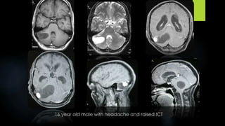 16 year old male with headache and raised ICT
 