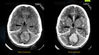 Non Contrast Post contrast
 