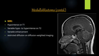 Medulloblastoma (contd.)
 MRI:
 Hypointense on T1
 Variable hypo‐ to hyperintense on T2
 Variable enhancement
 restricted diffusion on diffusion-weighted imaging
 