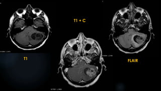 T1
T1 + C
FLAIR
 