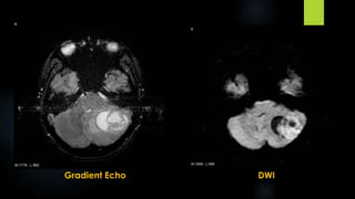 Gradient Echo DWI
 