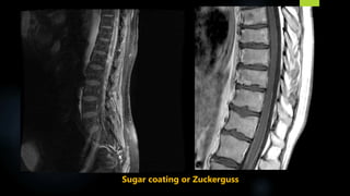 Sugar coating or Zuckerguss
 