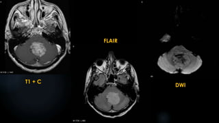 T1 + C
FLAIR
DWI
 