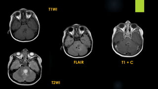 T1WI
T2WI
FLAIR T1 + C
 