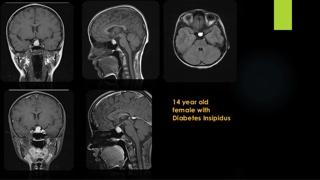 Diabetesinsipidus Penyebab Gejala Pengobatan