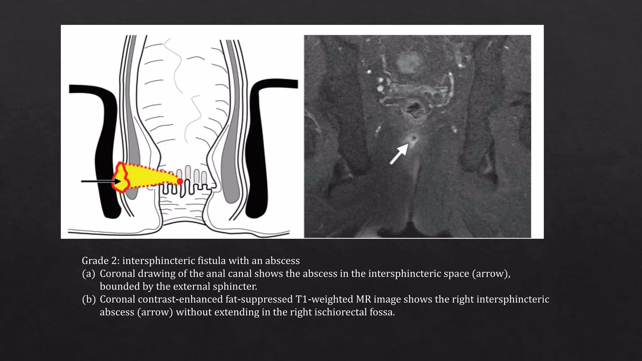 Radiological Imaging In Perianal Fistula PPTX