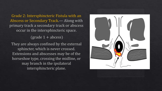 Radiological Imaging in perianal fistula | PPTX