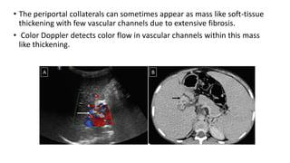 • The periportal collaterals can sometimes appear as mass like soft-tissue
thickening with few vascular channels due to extensive fibrosis.
• Color Doppler detects color flow in vascular channels within this mass
like thickening.
 