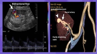 15
Bidirectional flow
Renal artery
Early draining
vein
pseudoaneurysm
 