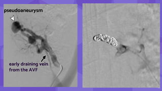 16
pseudoaneurysm
early draining vein
from the AVF
 