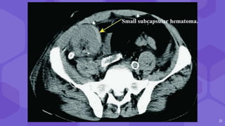 21
Small subcapsular hematoma.
 
