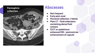 28
Abscesses
● Not frequent
● Early post renal
● Perirenal collection + febrile
● Plain CT - fluid collections
containing dense fluid
content
● CECT or gadolinium
enhanced MRI - postcontrast
enhancement of capsule
Perinephric
collection
 
