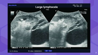 31
Large lymphocele
 