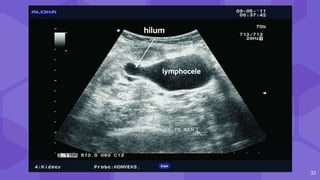 32
hilum
lymphocele
 