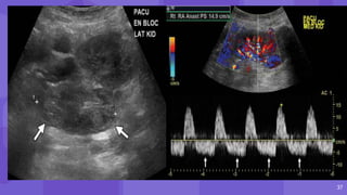 37
Renal vein filled with a large thrombus
 