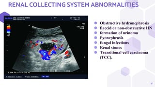41
RENAL COLLECTING SYSTEM ABNORMALITIES
⬢ Obstructive hydronephrosis
⬢ flaccid or non-obstructive HN
⬢ formation of urinoma
⬢ Pyonephrosis
⬢ fungal infections
⬢ Renal stones
⬢ Transitional-cell carcinoma
(TCC).
 