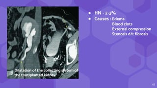 42
● HN - 2-3%
● Causes : Edema
Blood clots
External compression
Stenosis d/t fibrosis
Dilatation of the collecting system of
the transplanted kidney.
 