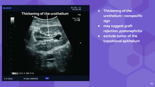 43
● Thickening of the
urothelium - nonspecific
sign
● may suggest graft
rejection, pyelonephritis
● exclude tumor of the
transitional epithelium
Thickening of the urothelium
 