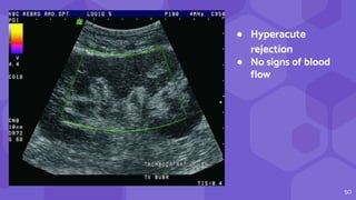 50
● Hyperacute
rejection
● No signs of blood
flow
 