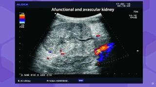 51
Afunctional and avascular kidney
 