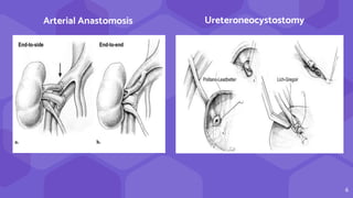 6
Ureteroneocystostomy
Arterial Anastomosis
 