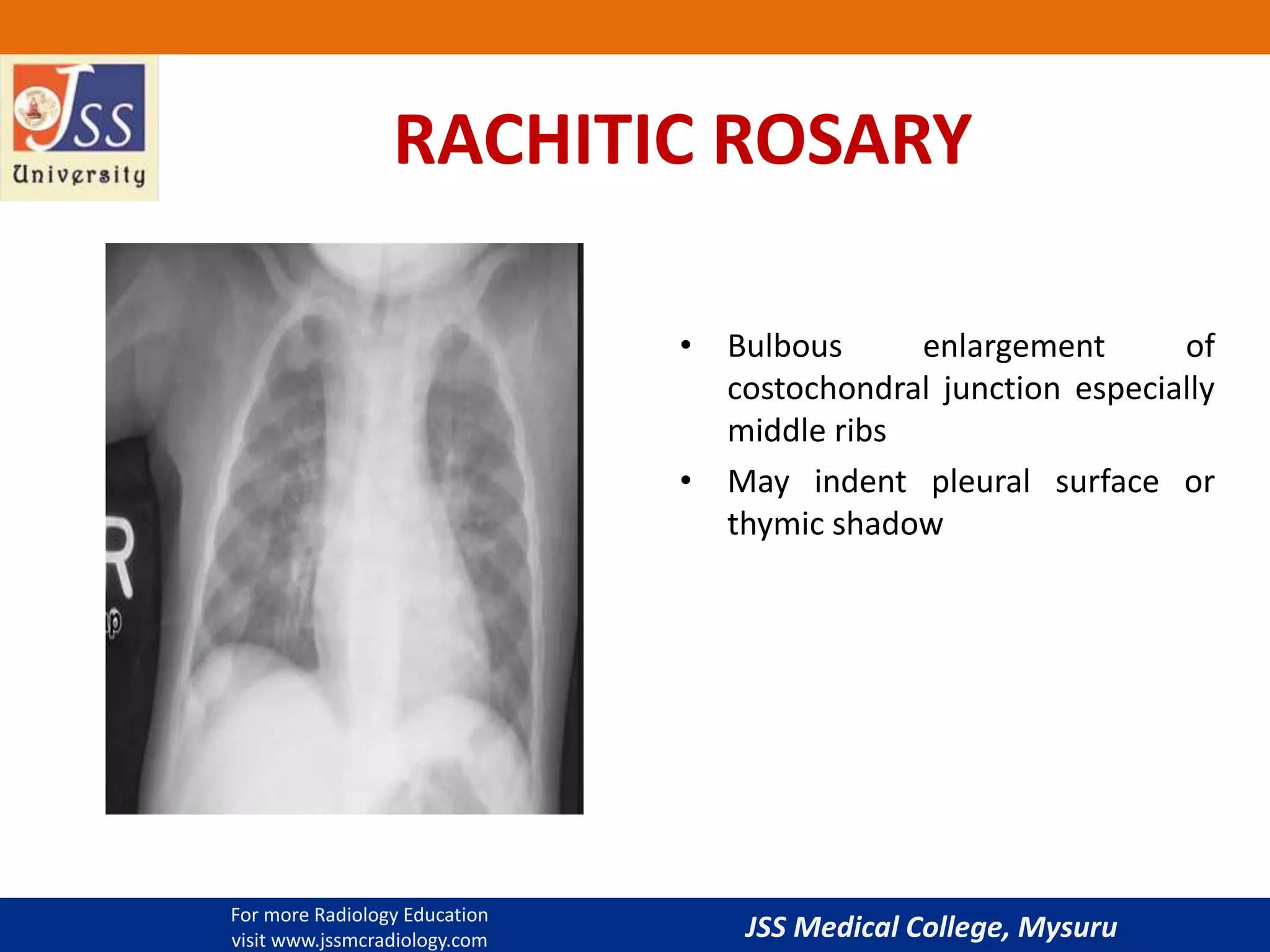 Imaging in rickets | PPTX