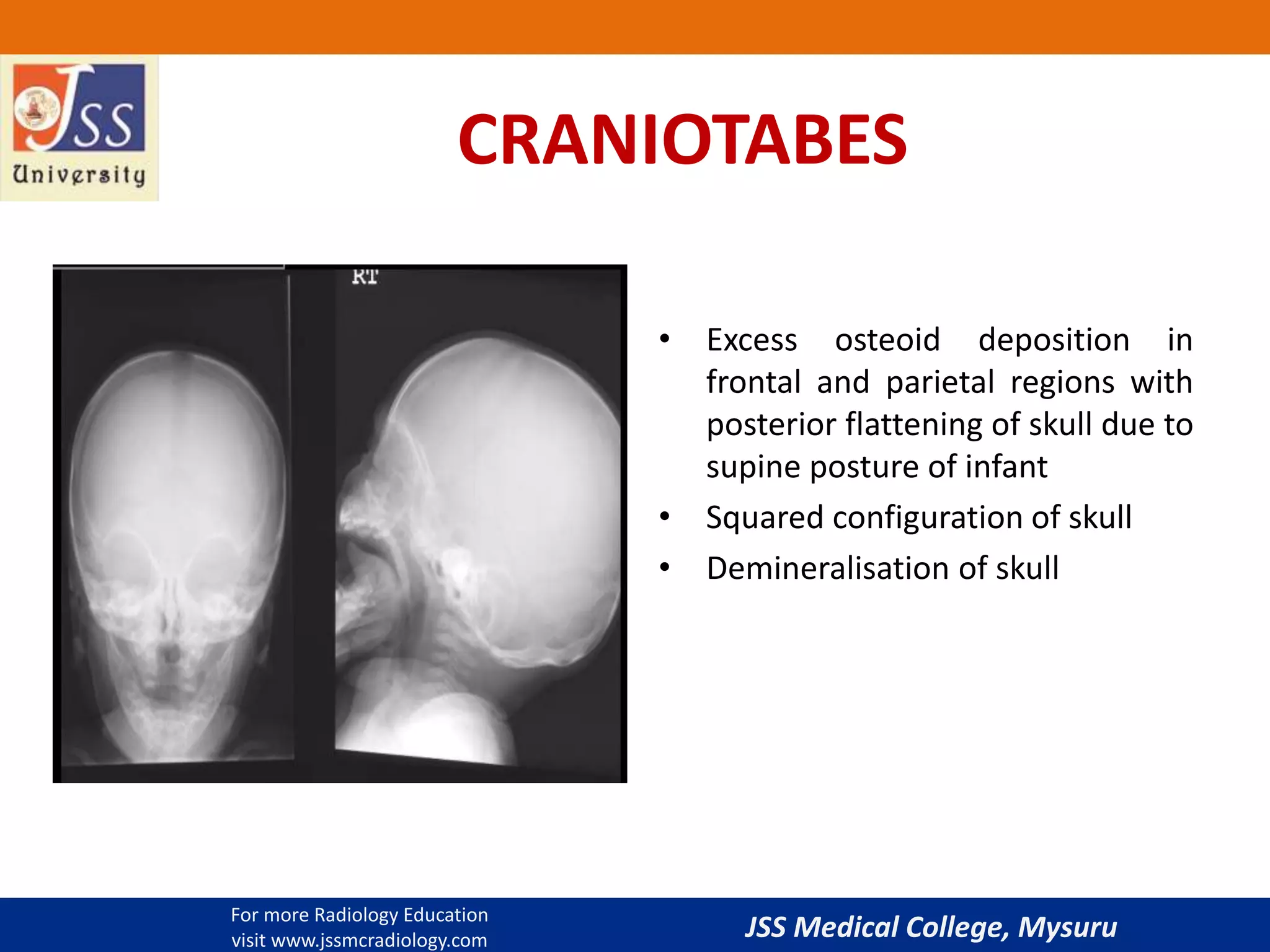 Imaging in rickets | PPTX