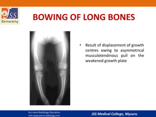 JSS Medical College, Mysuru
BOWING OF LONG BONES
• Result of displacement of growth
centres owing to asymmetrical
musculotendinous pull on the
weakened growth plate
For more Radiology Education
visit www.jssmcradiology.com
 