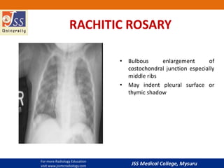 JSS Medical College, Mysuru
RACHITIC ROSARY
• Bulbous enlargement of
costochondral junction especially
middle ribs
• May indent pleural surface or
thymic shadow
For more Radiology Education
visit www.jssmcradiology.com
 