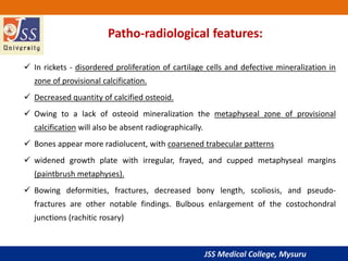 JSS Medical College, Mysuru
 In rickets - disordered proliferation of cartilage cells and defective mineralization in
zone of provisional calcification.
 Decreased quantity of calcified osteoid.
 Owing to a lack of osteoid mineralization the metaphyseal zone of provisional
calcification will also be absent radiographically.
 Bones appear more radiolucent, with coarsened trabecular patterns
 widened growth plate with irregular, frayed, and cupped metaphyseal margins
(paintbrush metaphyses).
 Bowing deformities, fractures, decreased bony length, scoliosis, and pseudo-
fractures are other notable findings. Bulbous enlargement of the costochondral
junctions (rachitic rosary)
Patho-radiological features:
 