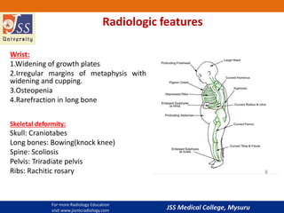 JSS Medical College, Mysuru
Radiologic features
Wrist:
1.Widening of growth plates
2.Irregular margins of metaphysis with
widening and cupping.
3.Osteopenia
4.Rarefraction in long bone
Skeletal deformity:
Skull: Craniotabes
Long bones: Bowing(knock knee)
Spine: Scoliosis
Pelvis: Triradiate pelvis
Ribs: Rachitic rosary
For more Radiology Education
visit www.jssmcradiology.com
 