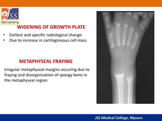 JSS Medical College, Mysuru
WIDENING OF GROWTH PLATE
• Earliest and specific radiological change
• Due to increase in cartilaginoous cell mass
Irregular metaphyseal margins occuring due to
fraying and disorganisation of spongy bone in
the metaphyseal region
METAPHYSEAL FRAYING
 