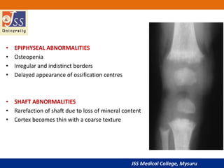 JSS Medical College, Mysuru
• EPIPHYSEAL ABNORMALITIES
• Osteopenia
• Irregular and indistinct borders
• Delayed appearance of ossification centres
• SHAFT ABNORMALITIES
• Rarefaction of shaft due to loss of mineral content
• Cortex becomes thin with a coarse texture
 