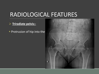 RADIOLOGICAL FEATURES
 Triradiate pelvis:-
 Protrusion of hip into the soft pelvis with protrusio acetabuli.
 