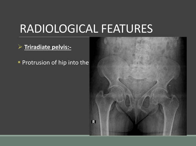 Imaging in rickets | PPTX | Bone and Joint Conditions | Diseases and ...