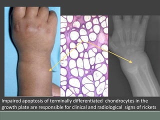 Impaired apoptosis of terminally differentiated chondrocytes in the
growth plate are responsible for clinical and radiological signs of rickets
 