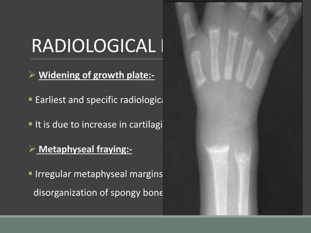 Imaging in rickets | PPTX | Bone and Joint Conditions | Diseases and ...