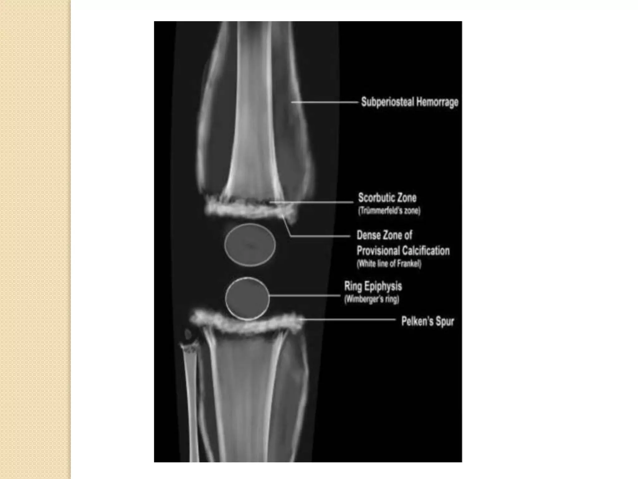 Imaging in Rickets & Scurvy.pptx