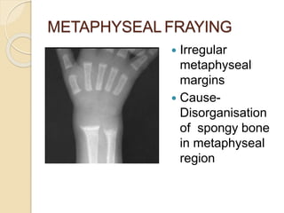 METAPHYSEAL FRAYING
 Irregular
metaphyseal
margins
 Cause-
Disorganisation
of spongy bone
in metaphyseal
region
 