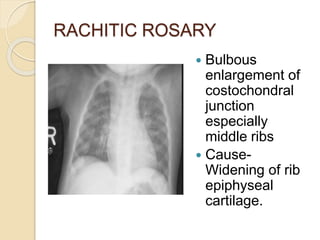 RACHITIC ROSARY
 Bulbous
enlargement of
costochondral
junction
especially
middle ribs
 Cause-
Widening of rib
epiphyseal
cartilage.
 