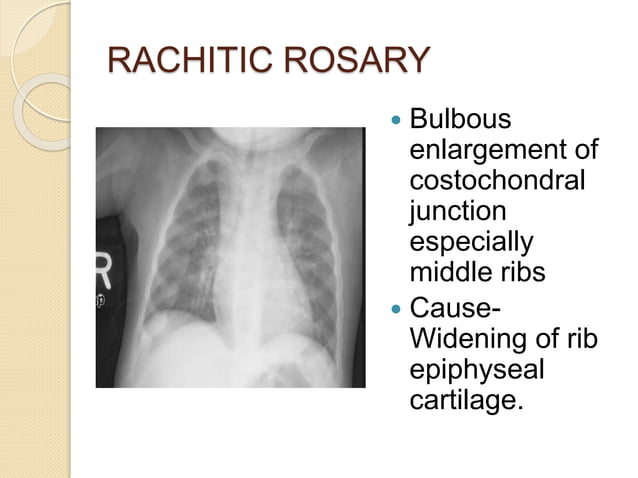 Imaging in Rickets & Scurvy.pptx