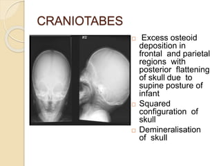 CRANIOTABES
 Excess osteoid
deposition in
frontal and parietal
regions with
posterior flattening
of skull due to
supine posture of
infant
 Squared
configuration of
skull
 Demineralisation
of skull
 
