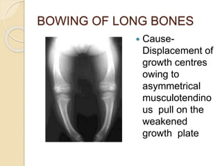 BOWING OF LONG BONES
 Cause-
Displacement of
growth centres
owing to
asymmetrical
musculotendino
us pull on the
weakened
growth plate
 